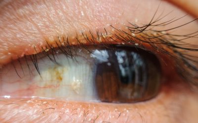 Bacterial overpopulation at the base of your eyelashes