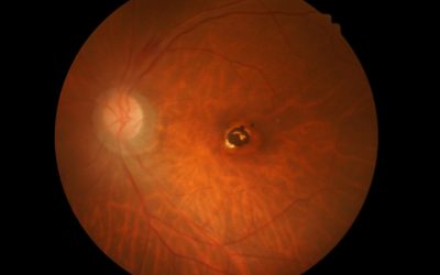 Macula hole: there’s a hole in my eye