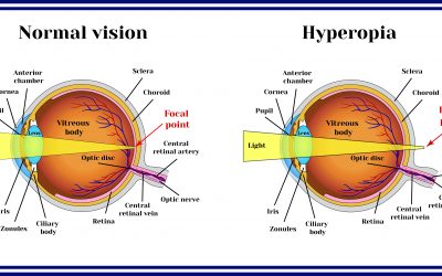 Hyperopia describes an inability to see up close