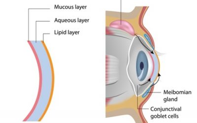 Meimbomian gland dysfunction: one cause of a dry eye