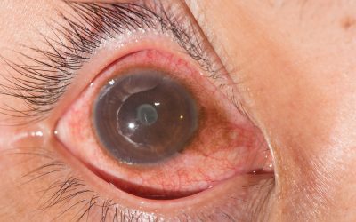 Uveitis is marked by pain and a red eye