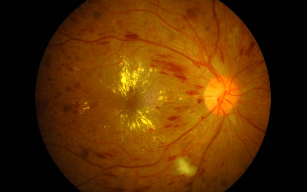 The Truth about Diabetic Retinopathy .